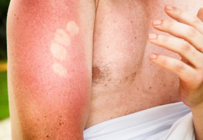 How to sleep with sunburn on arms?