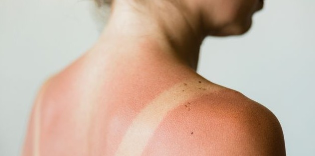 How to sleep with sunburn on the back?