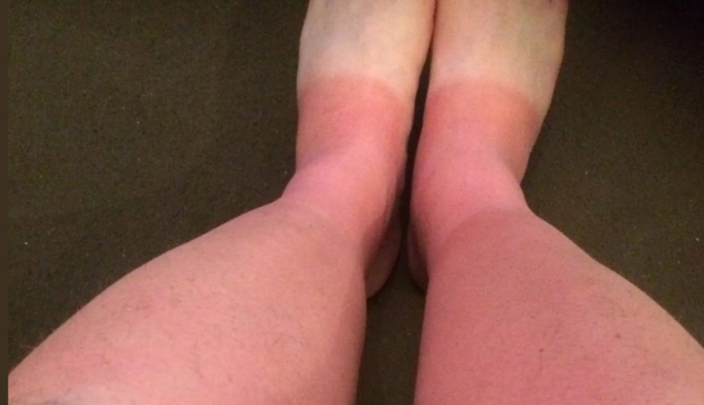 How to sleep with sunburn on your legs?